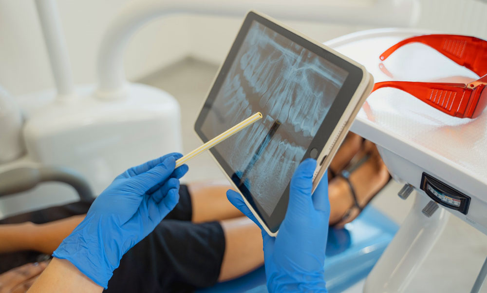A fog implantátum beültetés előnyei és hátrányai: érdemes belevágni?